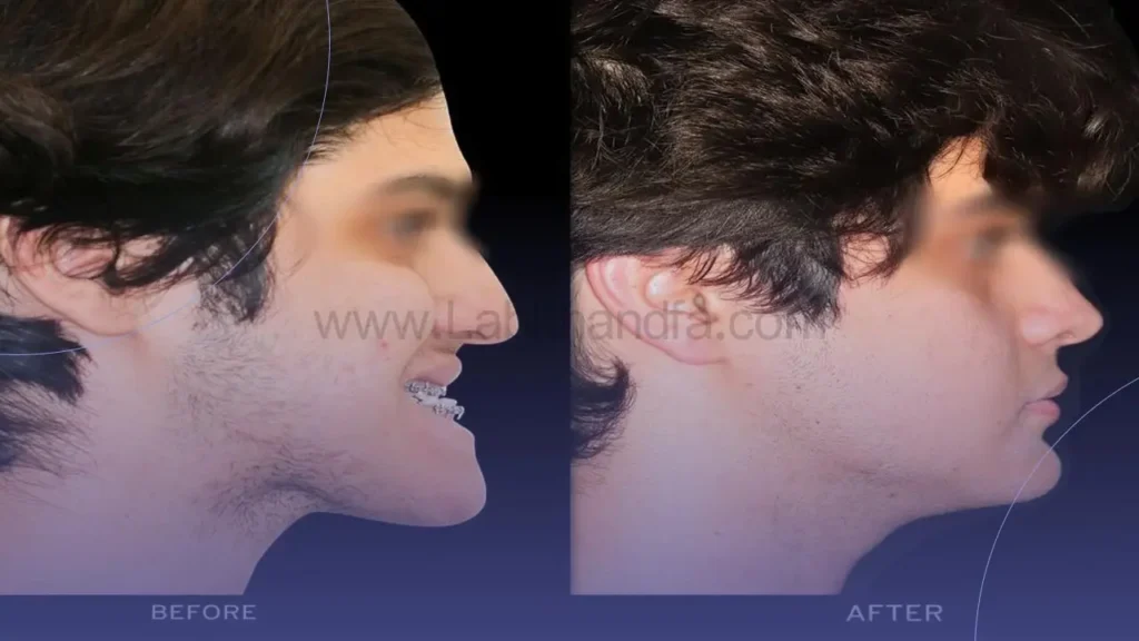 تاثیر ارتودنسی بر چانه 