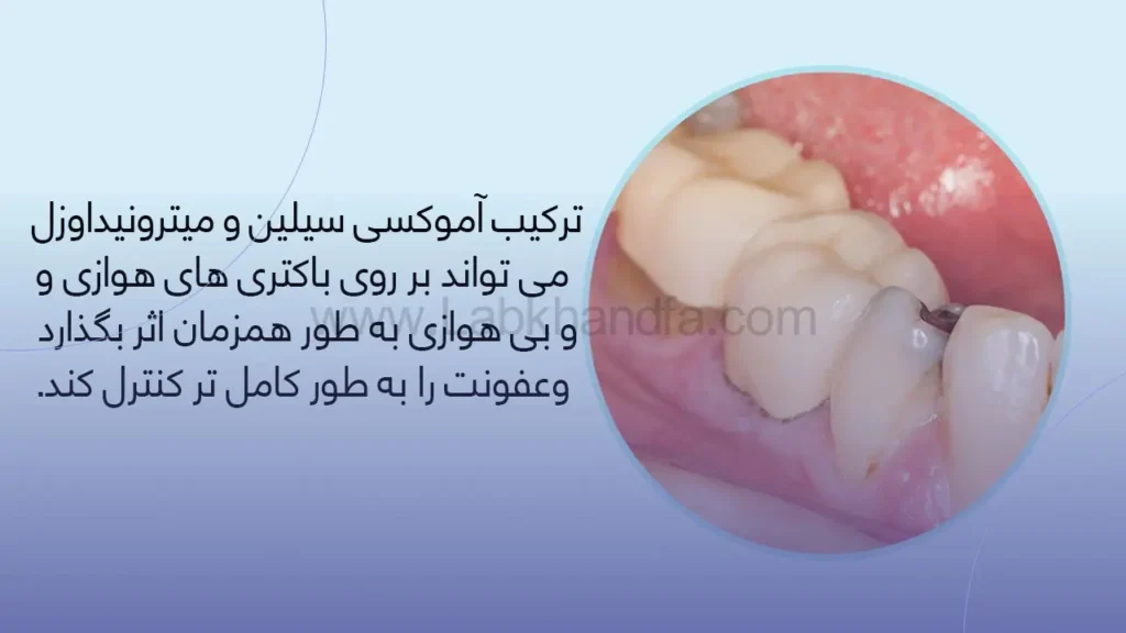 آنتی بیوتیک برای عفونت دندان 