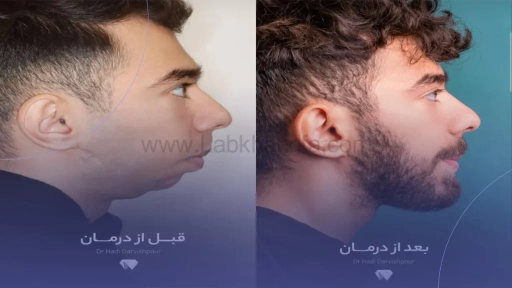 تاثیر ارتودنسی بر فرم لب 