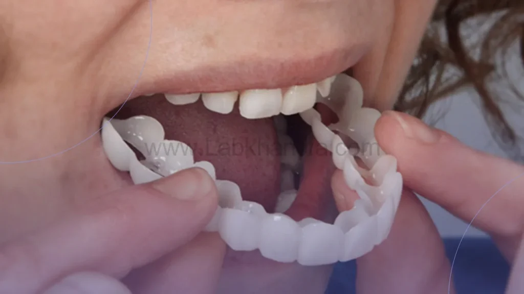 عکسی از لمینت دندان متحرک