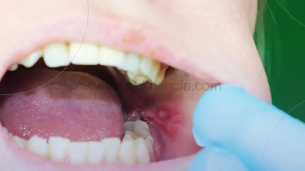 عکسی از عفونت لثه بعد از کشیدن دندان