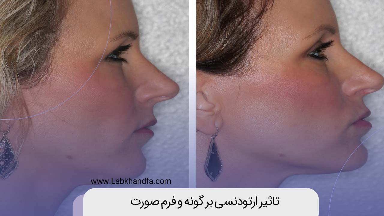 تاثیر ارتودنسی بر گونه و فرم صورت