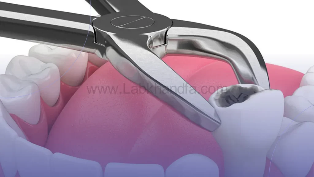 عکسی از کشیدن دندان آسیب دیده