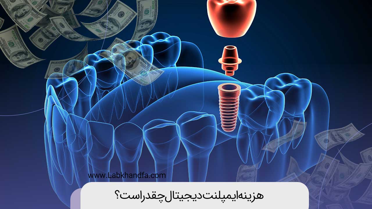 هزینه ایمپلنت دیجیتال چقدر است؟