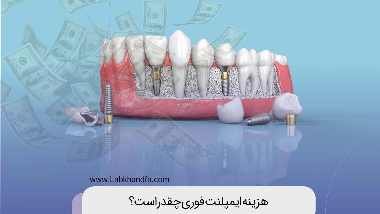 هزینه ایمپلنت فوری
