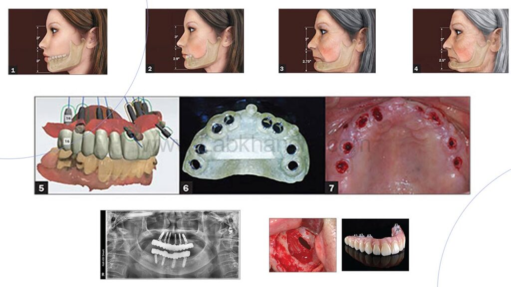 تکنولوژی مدرن ایمپلنت دیجیتال