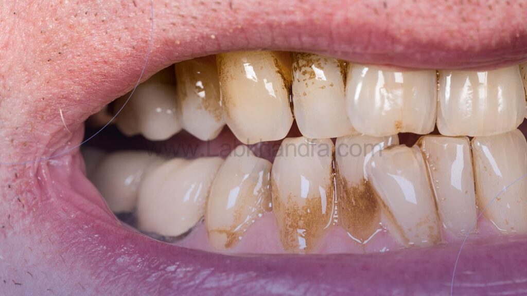 جلوگیری از پوسیدگی دندان با مصرف کلسیم