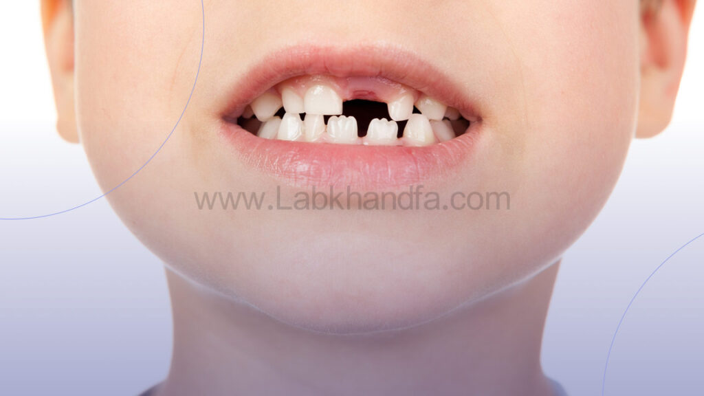 علت در نیامدن دندان کودکان بعد از افتادن دندان های شیری