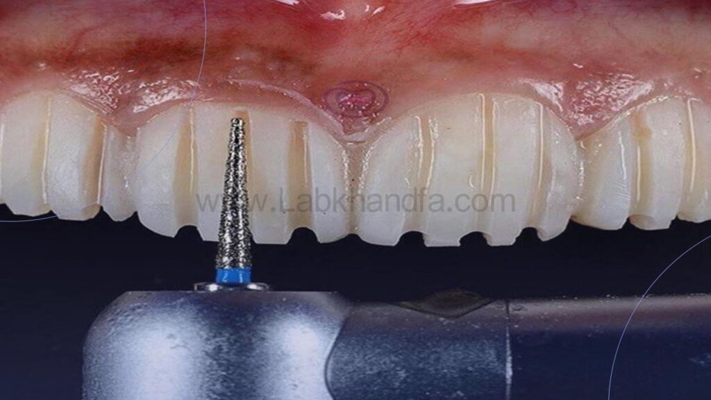 عکس از تراشیدن بافت های مینای دندان قبل از نصب لمینت