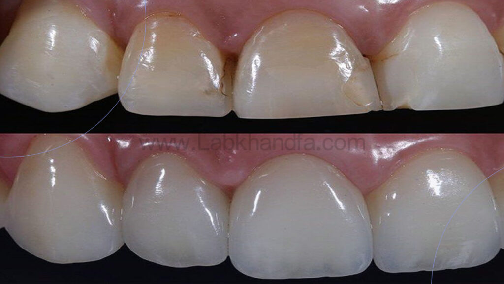 عکس قبل و بعد ترمیم کامپوزیت دندان