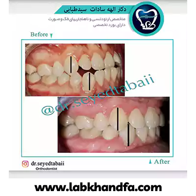 قبل و بعد نمونه کار ارتودنسی دندان دکتر الهه سیدطبائی