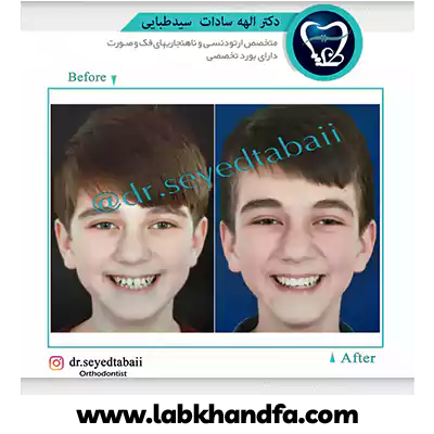قبل و بعد نمونه کار ارتودنسی دکتر الهه سیدطبائی