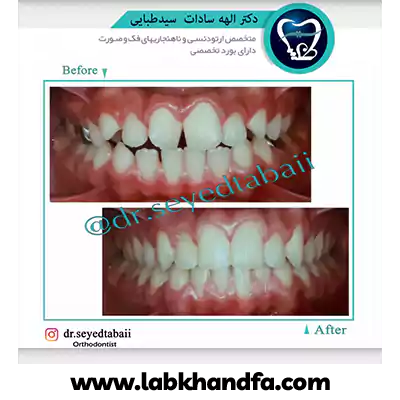 قبل و بعد نمونه کار درمان ارتودنسی دکتر الهه سیدطبائی