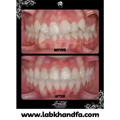 قبل و بعد نمونه کار درمان ارتودنسی دکتر مهدیه خسروی