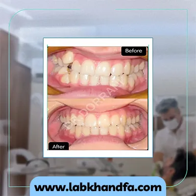 قبل و بعد یک نمونه کار دیگر نمونه کار ارتودنسی دکتر بهادر درانی