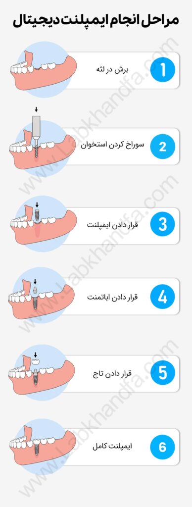 مراحل انجام ایمپلنت دیجیتال