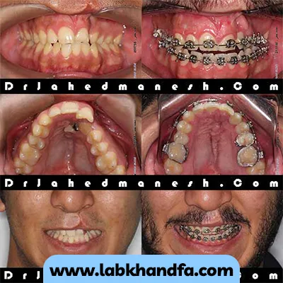 نمونه کار ارتودنسی دکتر مریم جاهید منش