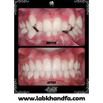 نمونه کار ارتودنسی دکتر مهدیه خسروی