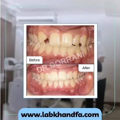 نمونه کار ارتودنسی دکتر بهادر درانی