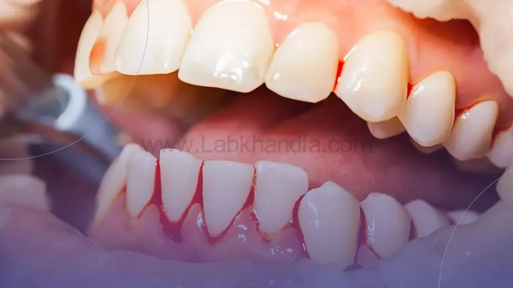 خونریزی لثه