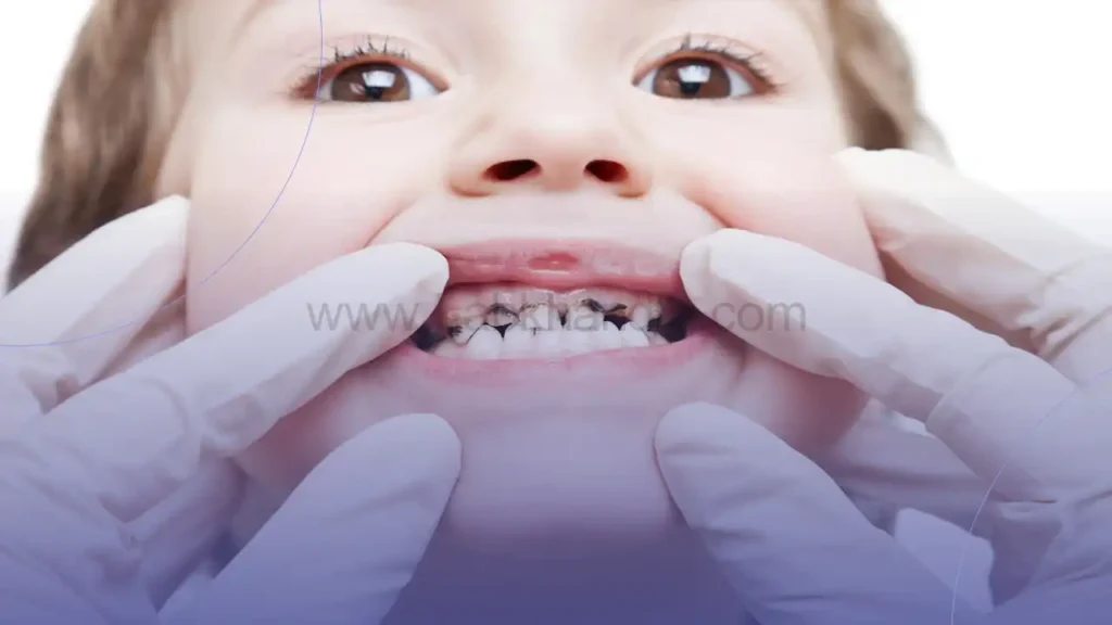 تصویر کودوکی که دندان های شیری او سیاه شده است و دندانپزشک در حال معاینه اوست