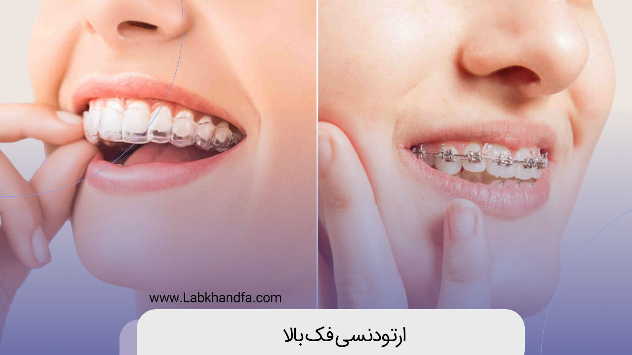 ارتودنسی فک بالا