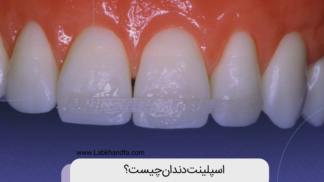 اسپلینت دندان چیست؟