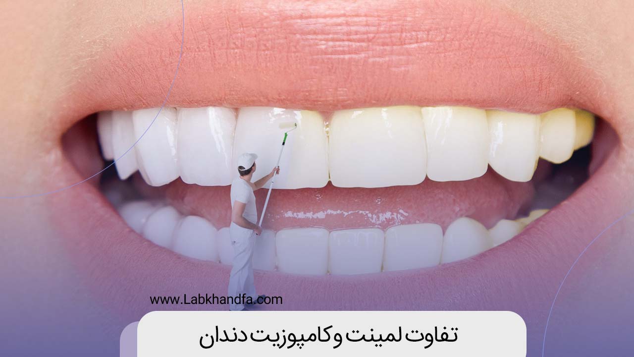تفاوت لمینت و کامپوزیت دندان