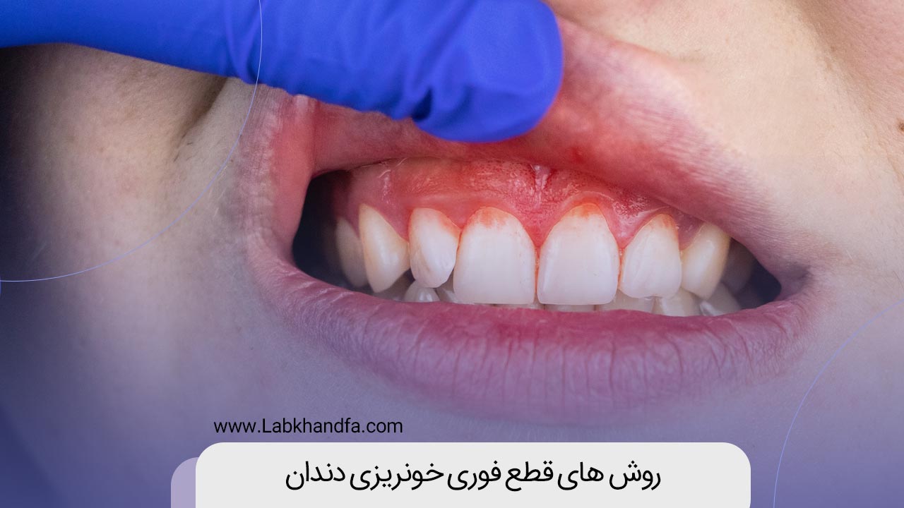 روش های قطع فوری خونریزی دندان