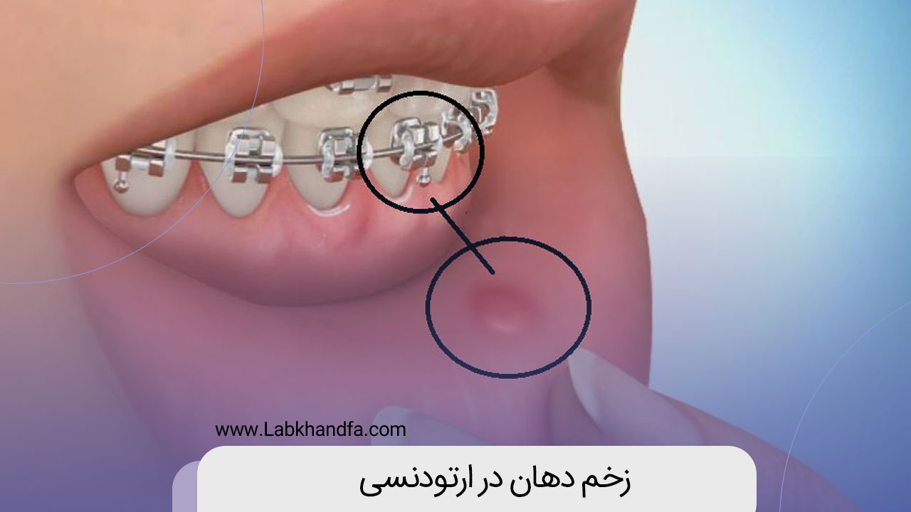 زخم دهان در ارتودنسی