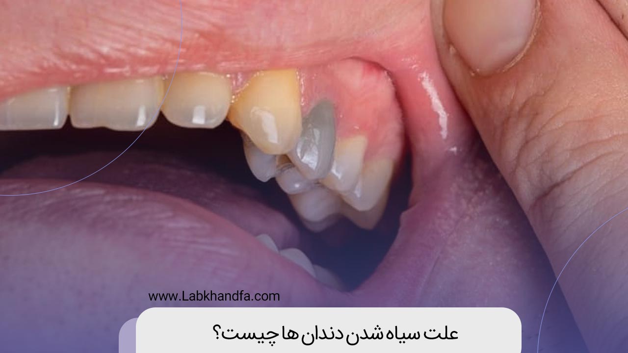 علت سیاه شدن دندان ها