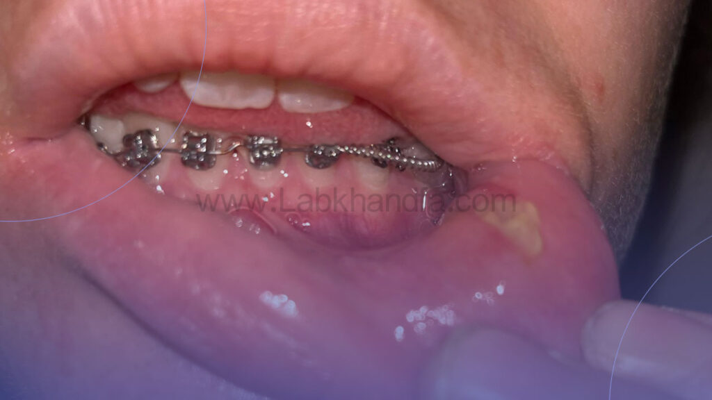 عکس زخم شدن دهان بعد از ارتودنسی
