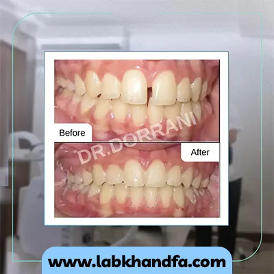 قبل و بعد نمونه کار ارتودنسی دکتر بهادر درانی