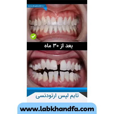 قبل وب عد نمونه کار ارتودسنی دکتر فرهاد صدرالدینی