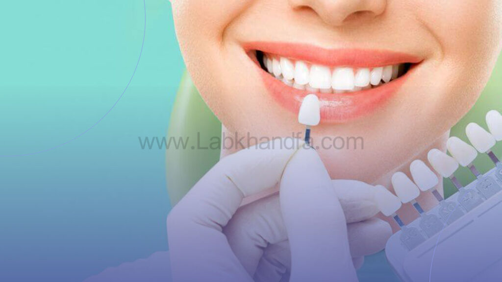 لمینت دندان