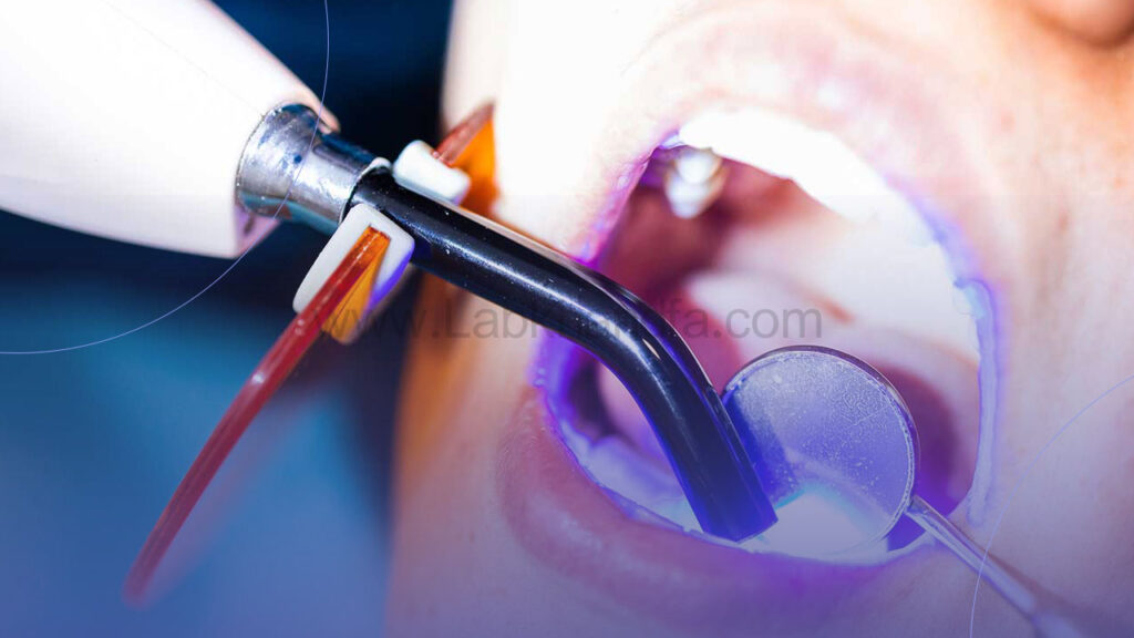 فرآیند پلیمریزاسیون در نصب کامپوزیت دندان