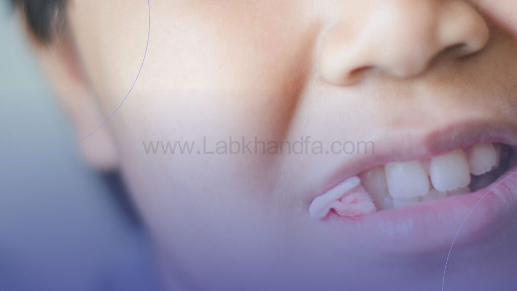 گذاشتن گاز استریل بعد از کشیدن دندان