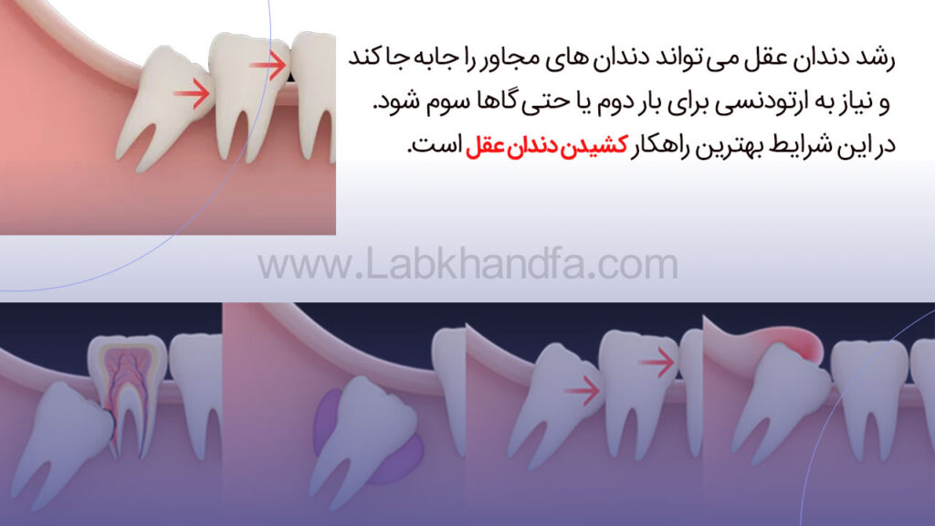 رشذ ذتذلت غقل و کج شدن دندان ها