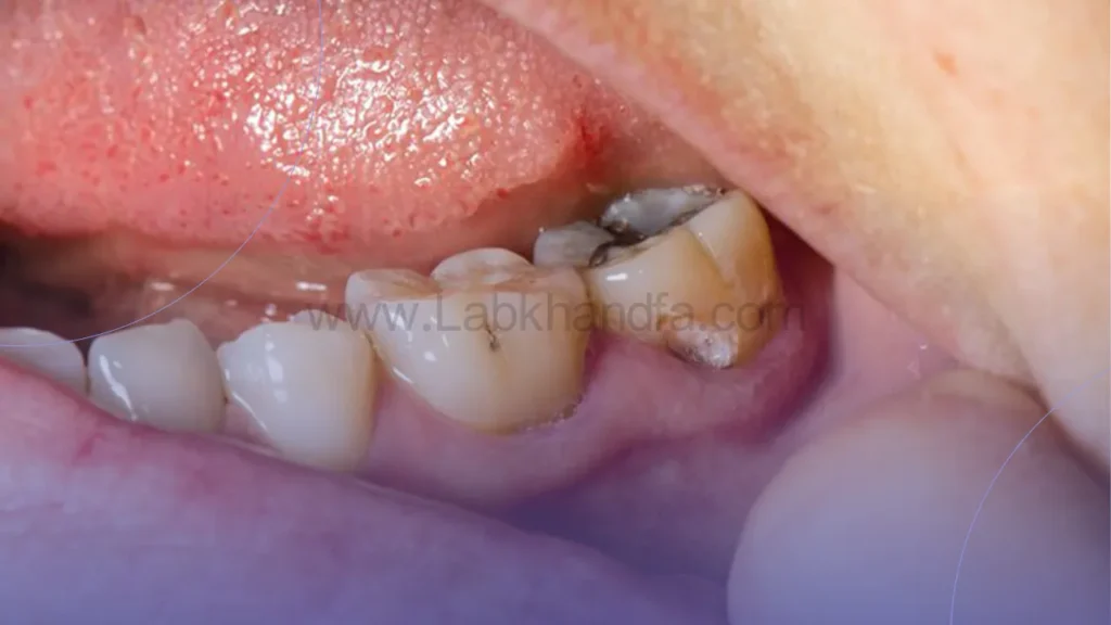 عکسی از قرمز شدن ناحیه اطراف دندان عفونتی