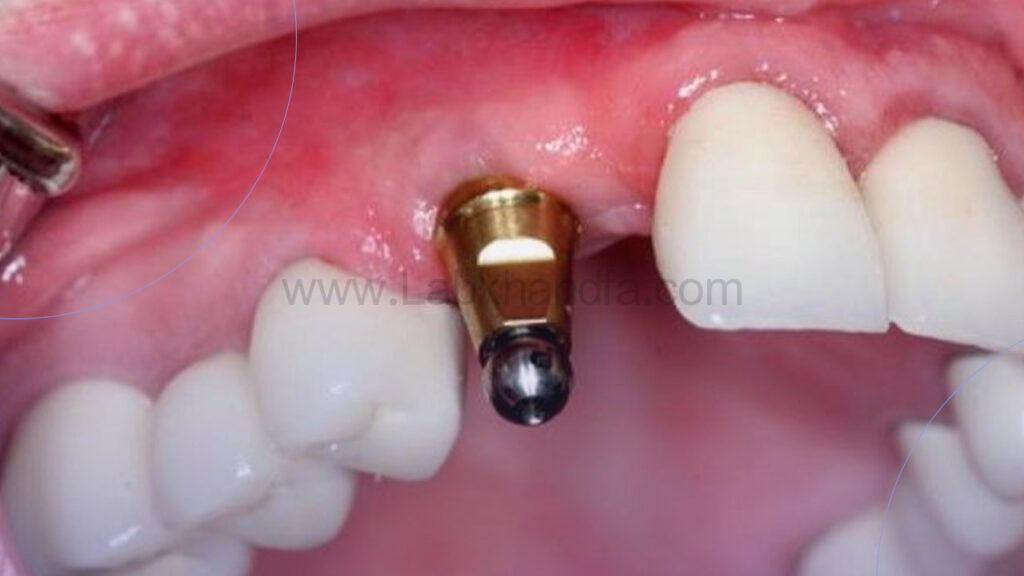 عکسی از کاشت ایمپلنت فوری یک روزه دندان