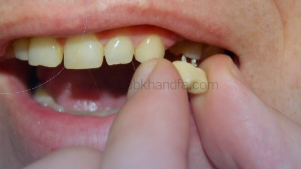 لق شدن ایمپلنت دندان