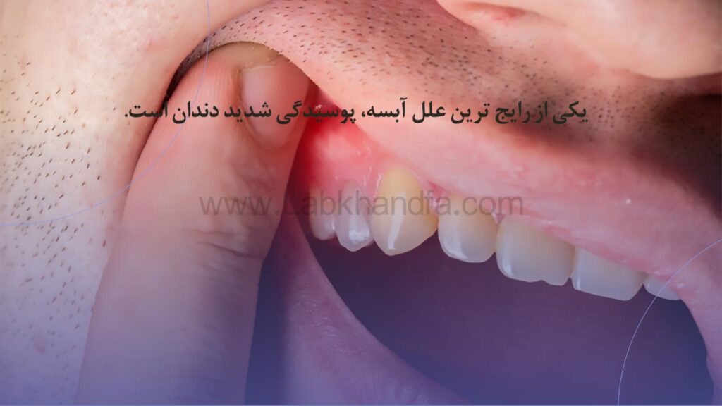 علل آبسه دندان