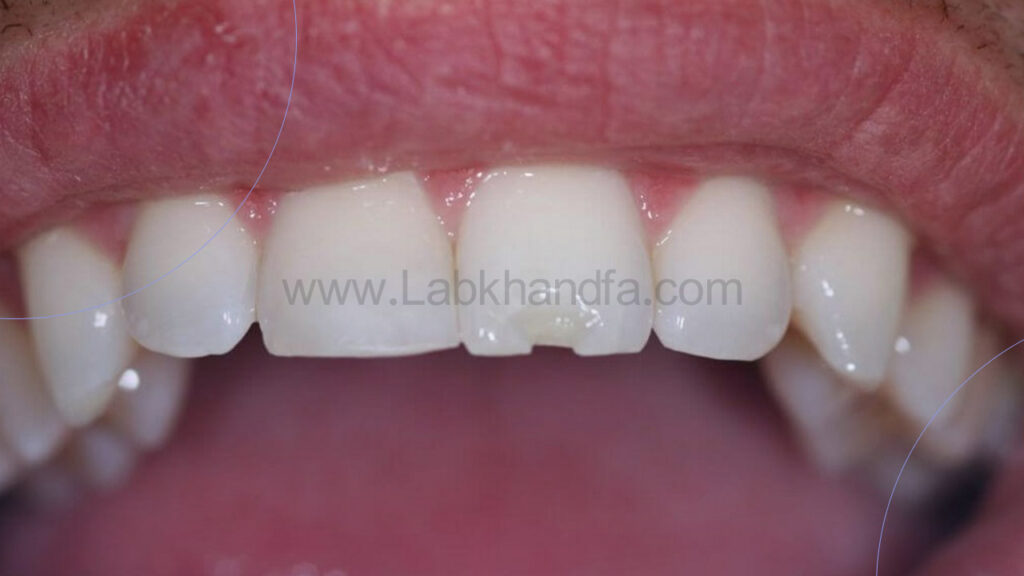 عکسی از شکستن روکش ایمپلنت دندان