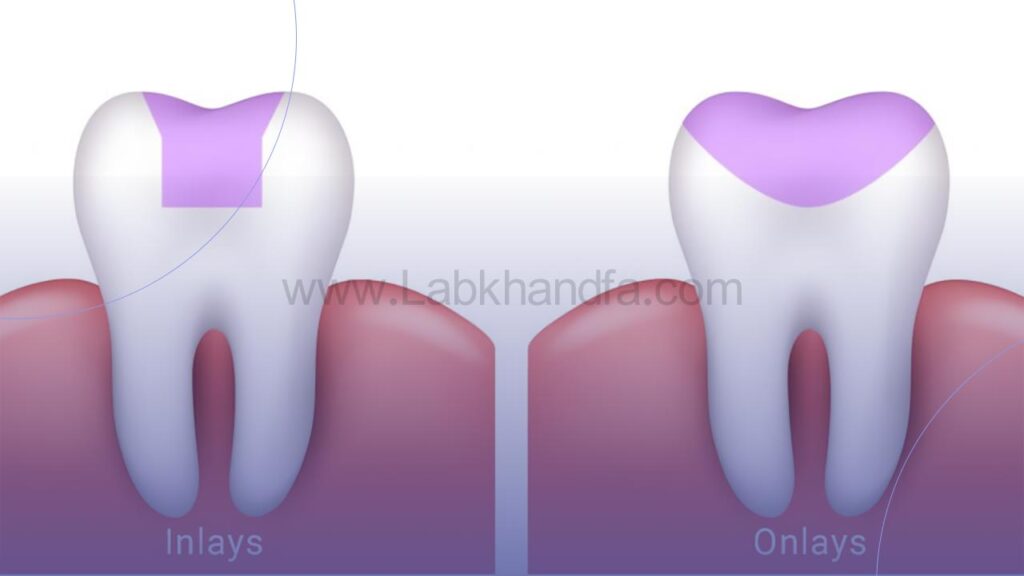 اینلی و آنلی