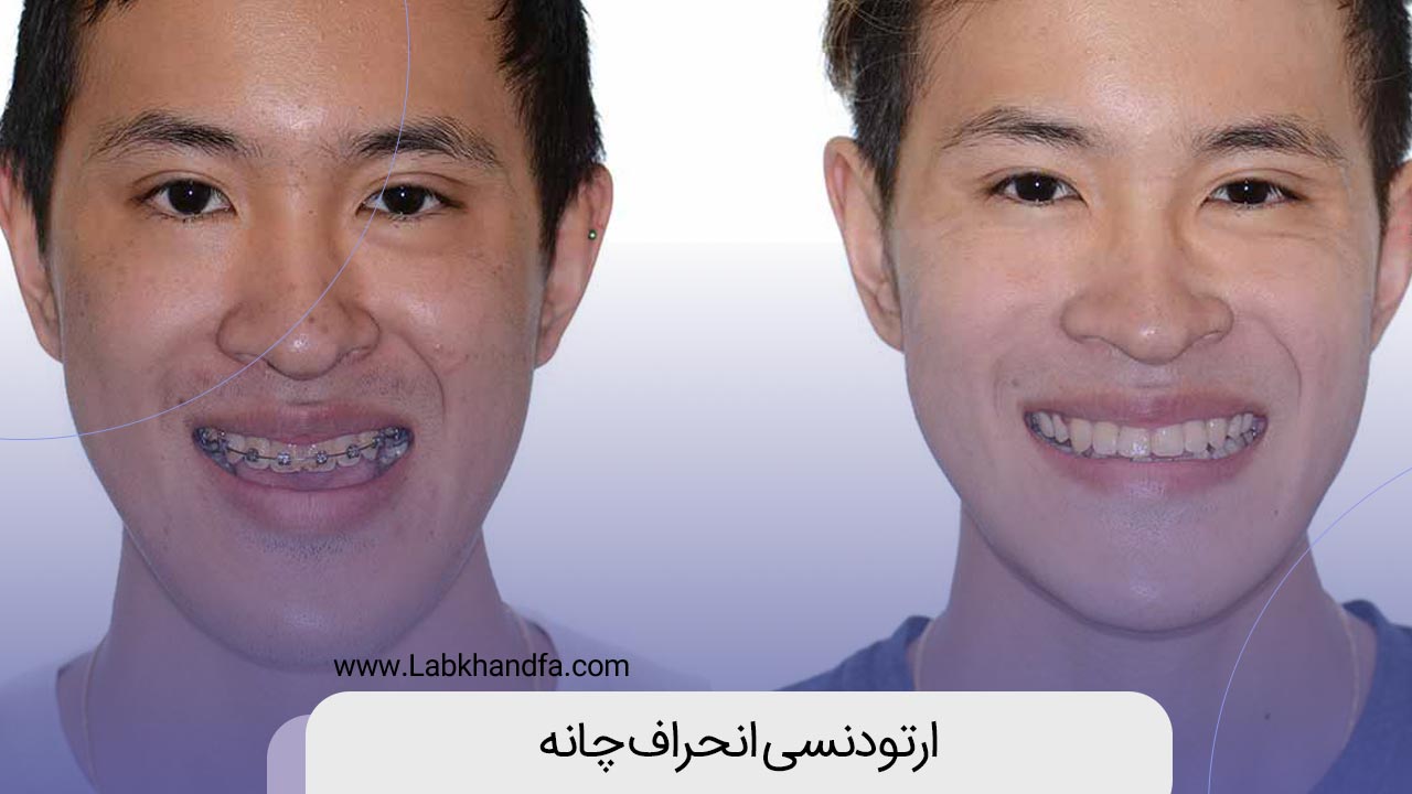ارتودنسی انحراف چانه