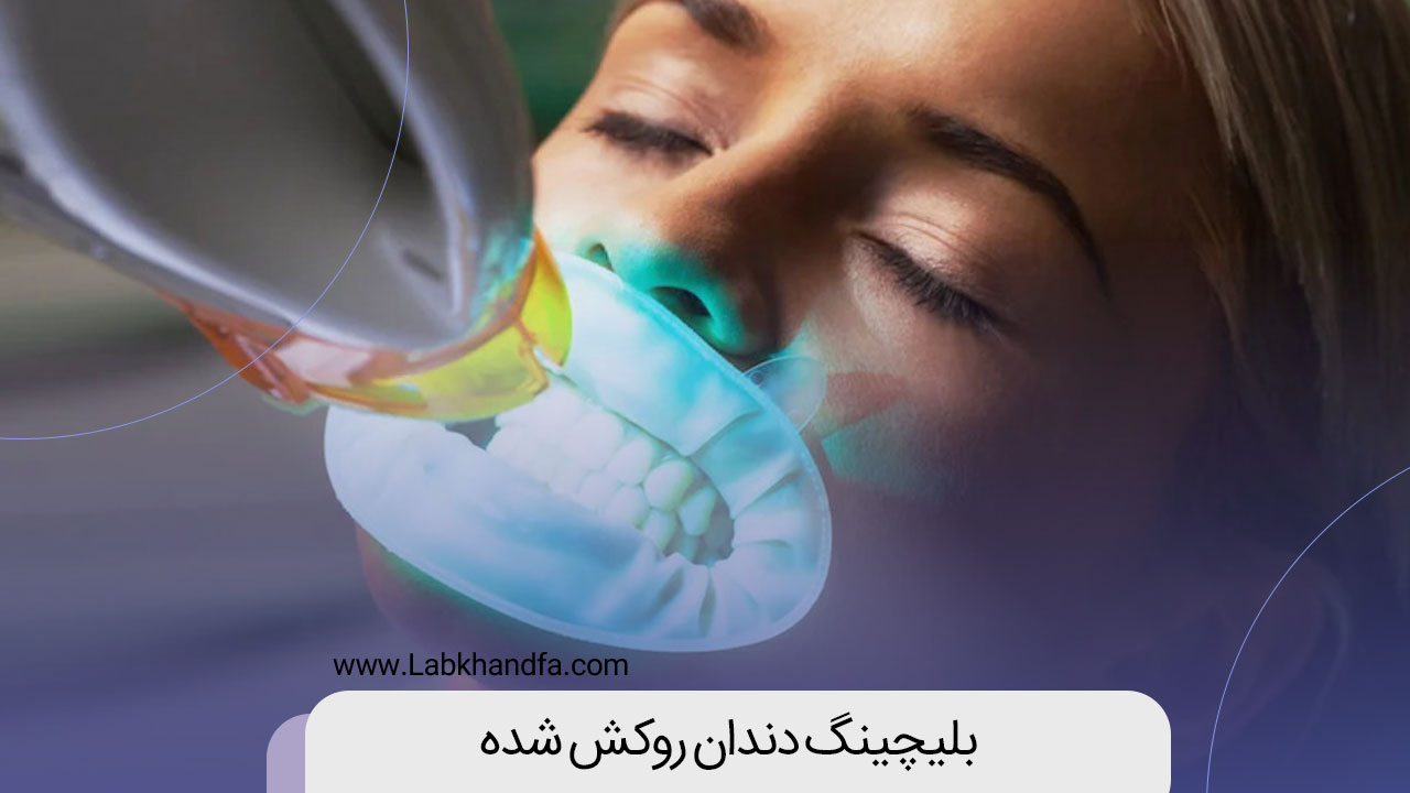 بلیچینگ دندان روکش شده