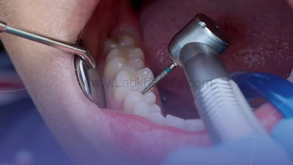 عکسی از عصب کشی دندان