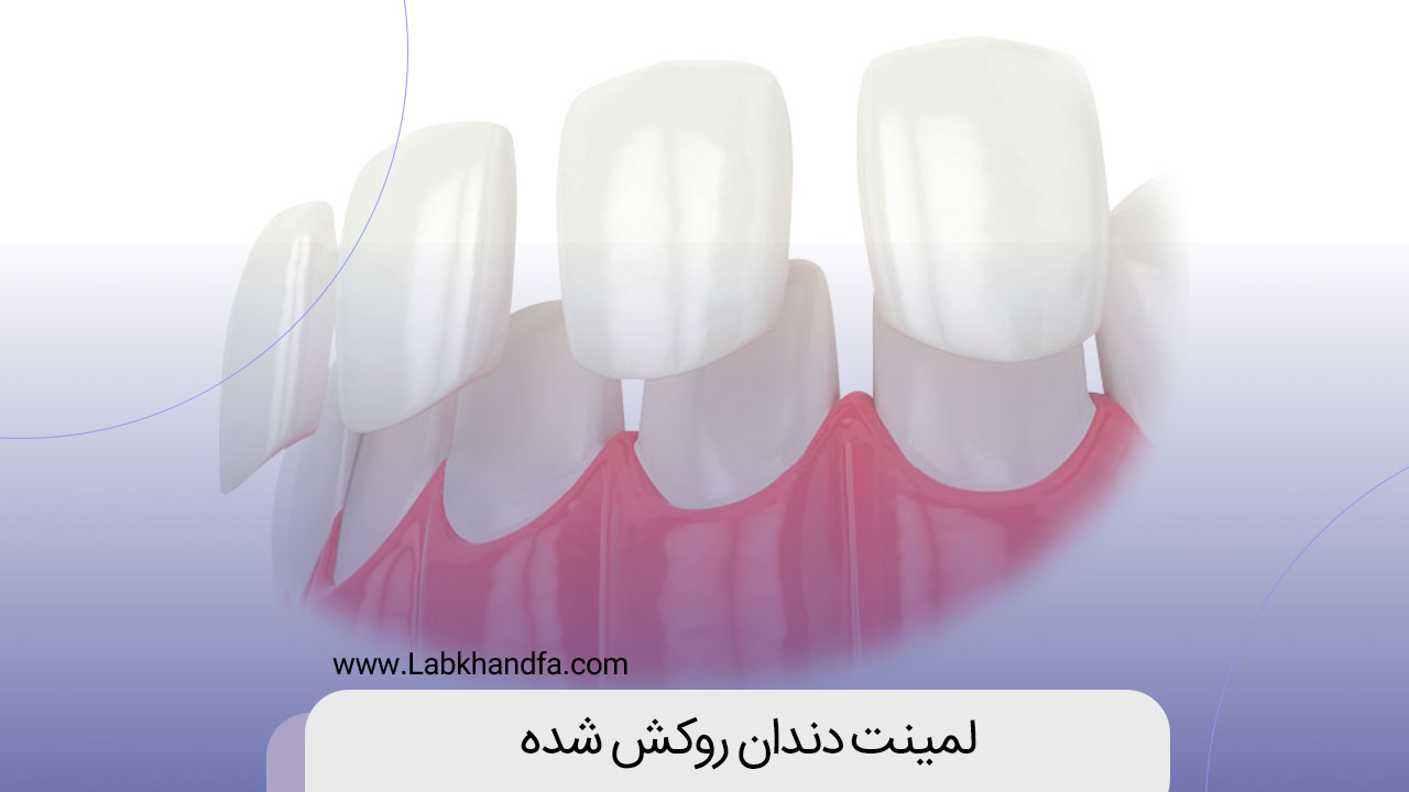 لمینت دندان روکش شده