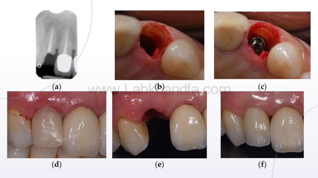 مراحل کاشت ایمپلنت فوری دندان