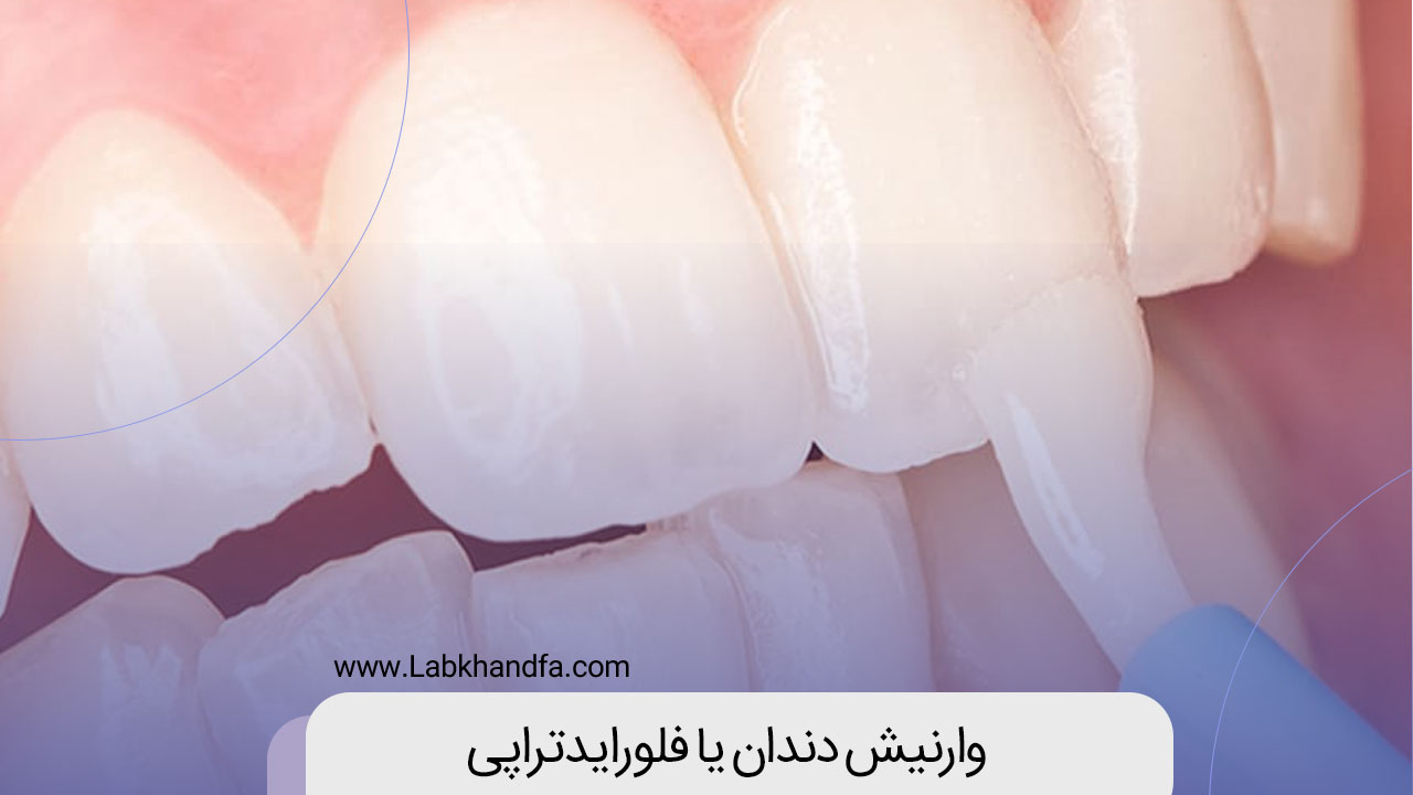 وارنیش دندان یا فلورایدتراپی